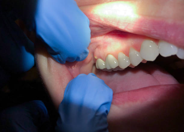 Best Emergency Care for Gum Disease in Reinbeck, IA